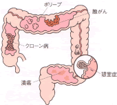大腸内視鏡検査